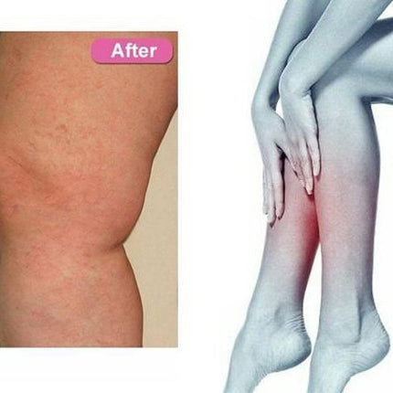 Varicose Vein Skin care lotion