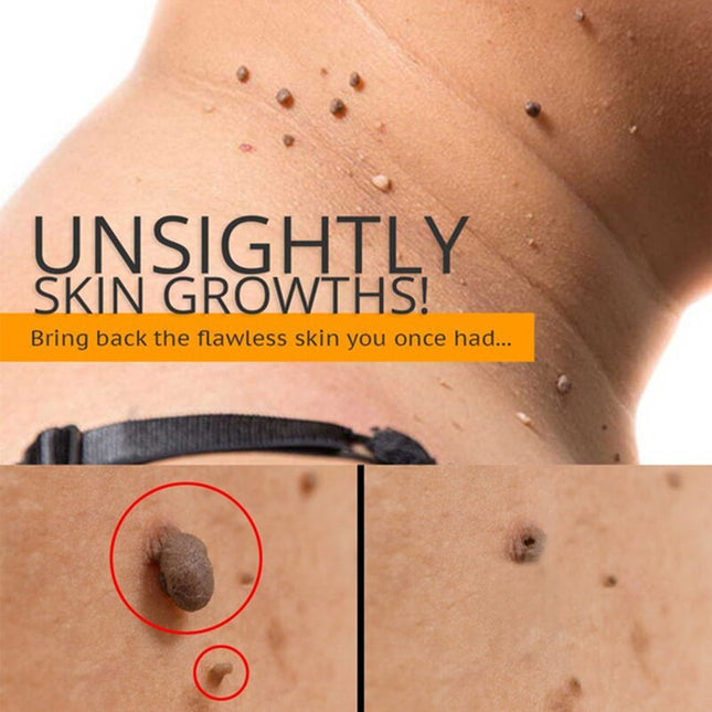120/360pcs Skin Tags Remover Wart Treatment Instant Removal Acne Corn