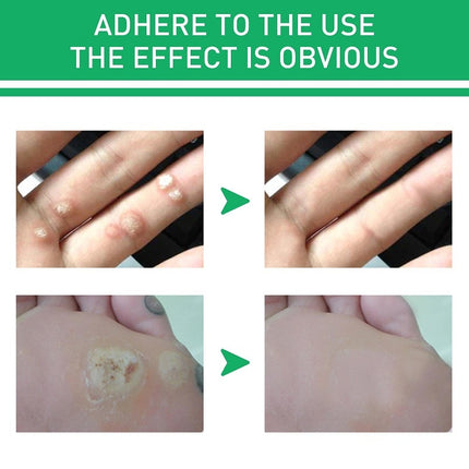 Effectively Remove Foot Corn Care Cream Remove Foot Calluses Remove