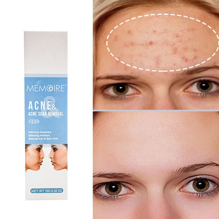 Herbal Acne Removal Face Cream Oil Control Anti-acne Gel Treatment