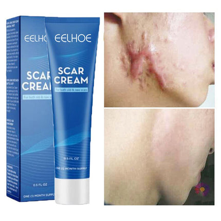 Herbal Scar Removal Face Cream Treatment Stretch Marks Burns Surgery
