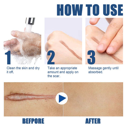Herbal Scar Removal Face Cream Treatment Stretch Marks Burns Surgery