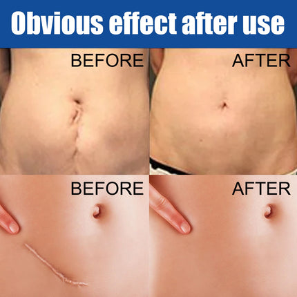 Herbal Scar Removal Face Cream Treatment Stretch Marks Burns Surgery
