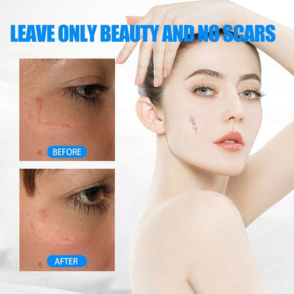Natural Scar Removal Cream Gel Whiten Pock Mark Burn Surgical Scar