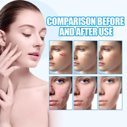 Natural Scar Removal Cream Gel Whiten Pock Mark Burn Surgical Scar