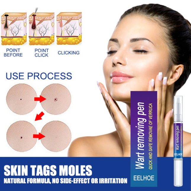 Skin Tag Remover Against Mole & Genital Wart Fast RemovWithin Al Anti
