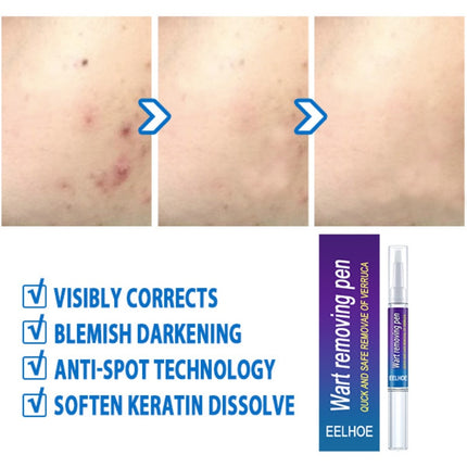 Skin Tag Remover Against Mole & Genital Wart Fast RemovWithin Al Anti