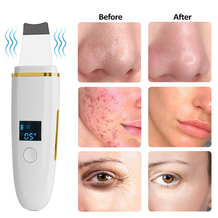Z9 Facial Skin Scrubber Ultrasonic Shovel Cleaner Dead Skin Peeling